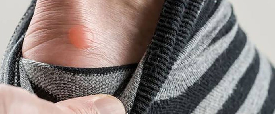 ফোসকার হাত থেকে ঝটপট মুক্তি পেতে করণীয় Blister Foska