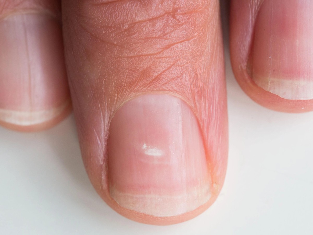 white spot on nail